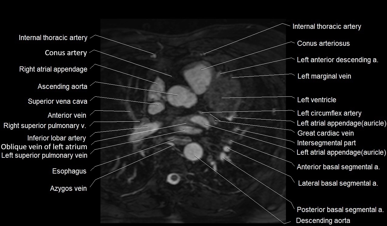 MRI heart coronary arteries and coronary veins anatomy axial image 14.webp